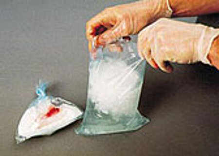 Amputat in einem wasserdichten Beutel auf Eis bzw. kühl legen