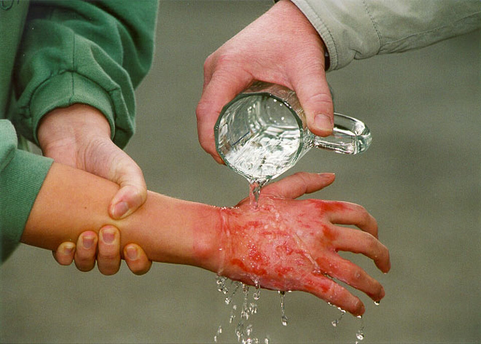 Verbrennungen & Brandwunden behandeln DRK e.V.