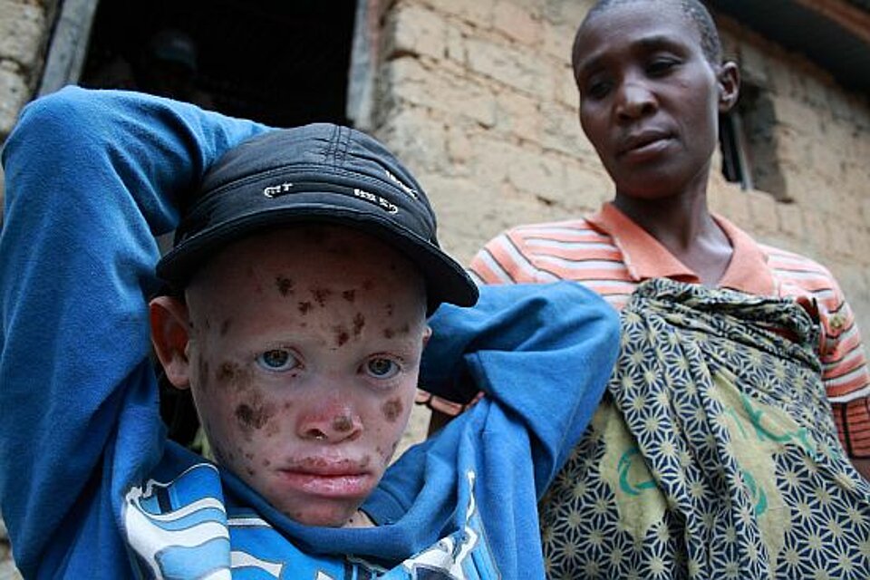 Foto: Eine junge Albinomutter mit ihrem Kind im Arm