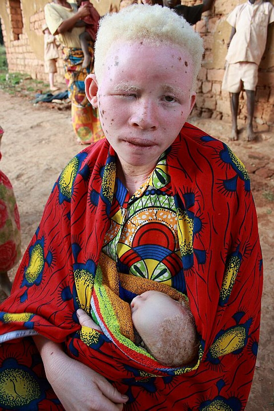 Foto: Ein Albinojunge mit einer blauen Schirmmütze, in seinem blassen Gesicht hat er viele dunkle Flecken