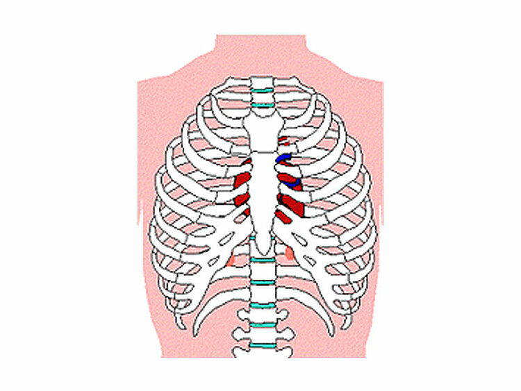 Position des Herzens - Herzdruckmassage