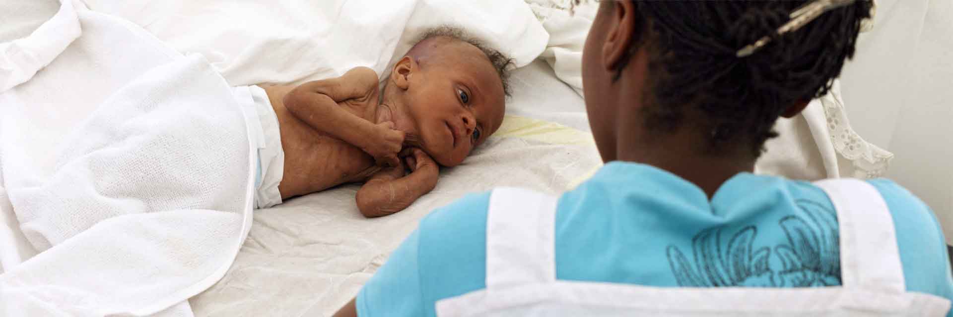 Unterernährung in Burkina Faso