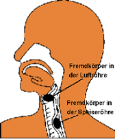 Fremdkorper In Luftrohre Oder Speiserohre Was Tun Drk E V